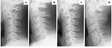 Representative Radiographs Of Subtypes Of Ossification Of Posterior