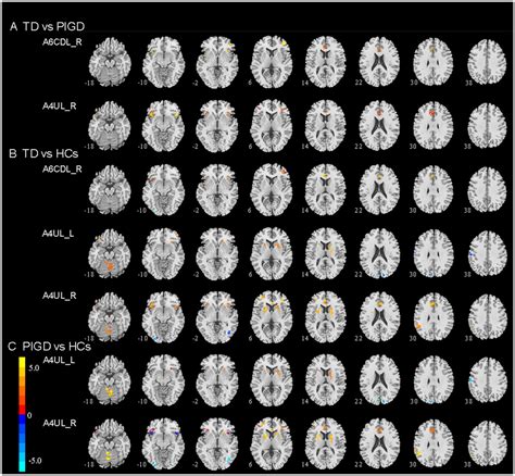 Frontiers Altered Functional Connectivity Of The Primary Motor Cortex