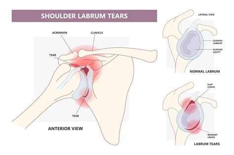 Shoulder Pain When You Serve Diagnose And Treat A Shoulder Injury