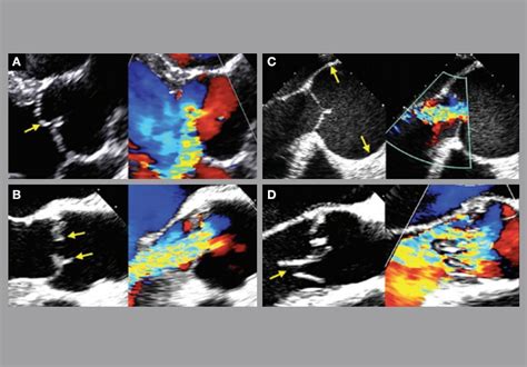 Earlier Intervention May Improve Outcomes In Patients With Aortic Valve