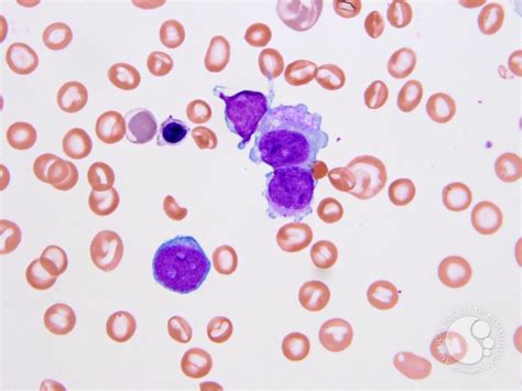 Transient myeloproliferative disorder