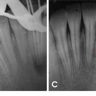 Diagrammatic Representation Of The Complex Root Canal Morphology As