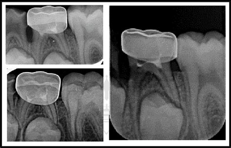 PDF Partial Versus Complete Pulpotomy Using Three Different Materials