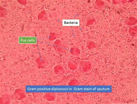 Gram positive diplococci in Gram stain of sputum - universe84a