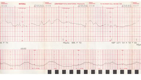 Fetal Heart Rate Monitoring Practice Quiz - Answers Fanatic