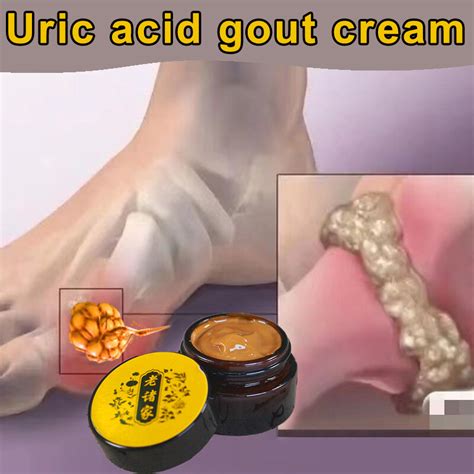 Gout Treatment Cream Pain Relief gout uric acid medicine Gout Leg Joint ...