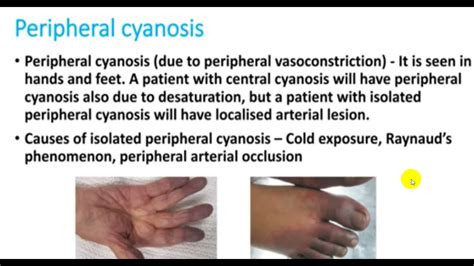 Central Cyanosis Vs Peripheral Cyanosis