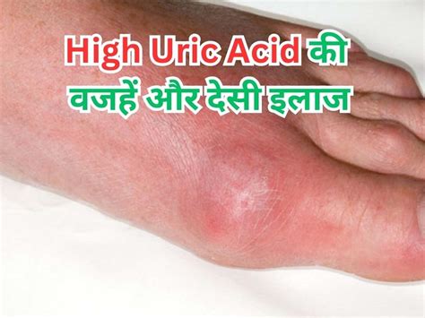 High Uric Acid Causes And Remedies How To Control High Uric Acid High Uric Acid High Uric