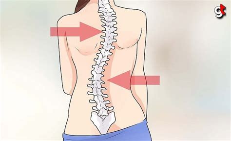 Omurga E Rili I Skolyoz Nedir Nas L Tedavi Edilir Sa Lik Haberleri