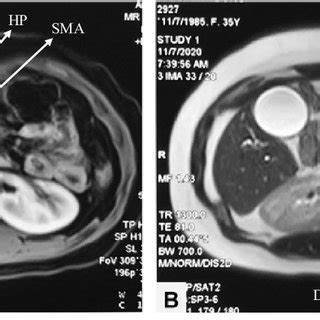 Preoperative MRCP A Post Contrast T1 Weighted Axial Image Shows D3