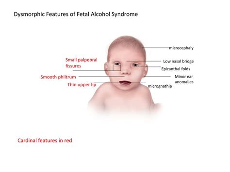 Fetal Alcohol Syndrome Presentation