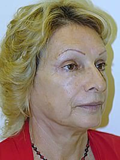 Facelift Dr Maan Kattash Cirug A Pl Stica En Los Angeles