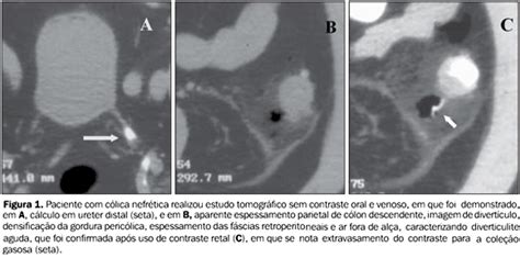 Radiologia Brasileira Tomografia Computadorizada Sem Contraste