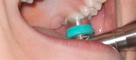 Gaseous Ozone For Root Canal Therapy Casemasters Blog