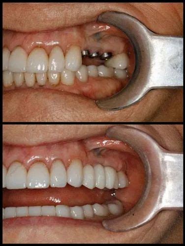 Metallic Non Surgical Dental Implant Surgery Service For Replacement