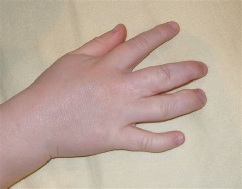 Syndactyly