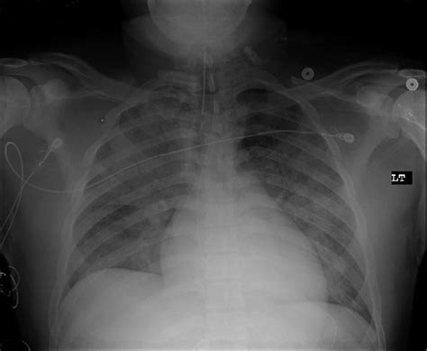 An Antero Posterior Chest Radiograph Demonstrating Diffuse Pulmonary