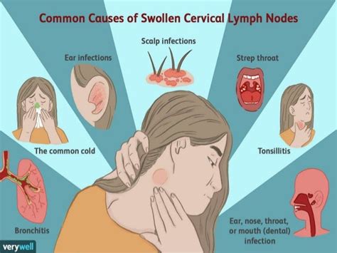 Differential Diagnosis Of Lymphadenopathy