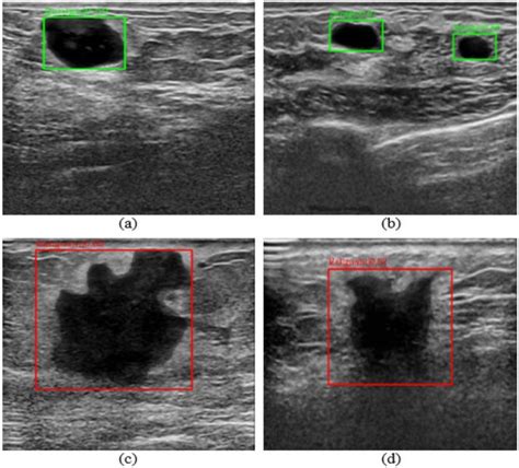 Multi Cancer Segmentation For Ultrasound Breast Imaging As A Result Of