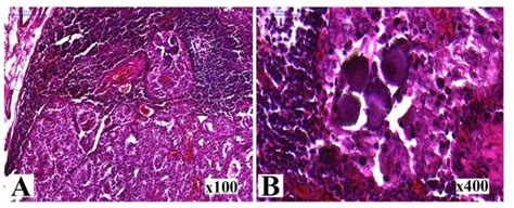 17 Histological Examination Of The Ptc A The Classic Version Of Ptc