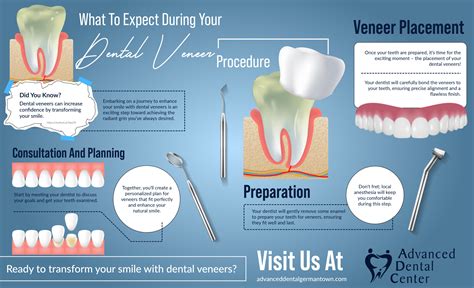 A Step-By-Step Look At The Dental Veneer Procedure – TYEX