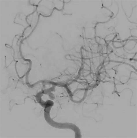 Lateral Supraorbital Craniotomy For Left Pcom Aneurysm With Oculomotor