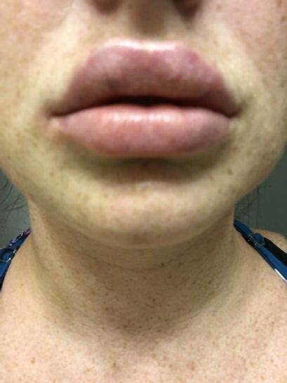 Tiny White Dots On Lips After Filler Lipstutorial Org