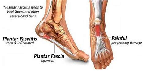 What Causes Plantar Fasciitis