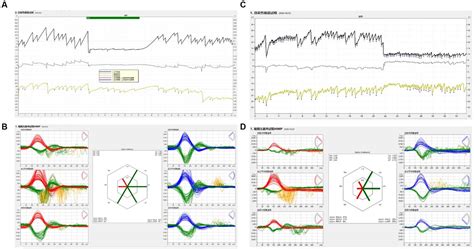 Frontiers Characteristics Of Spontaneous Nystagmus And Its Correlation To Video Head Impulse