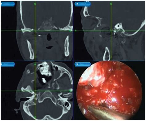Angiofibroma Inside Nose