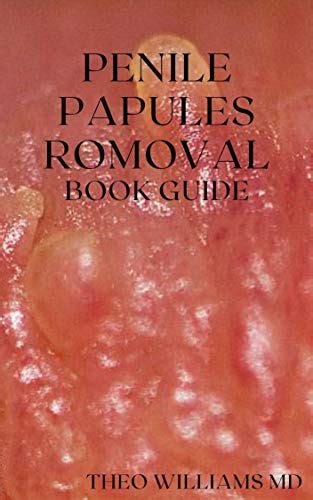 Pearly Penile Papules Removal