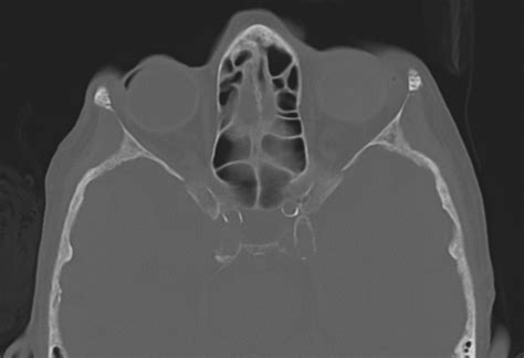 Globe Rupture Image Radiopaedia Org