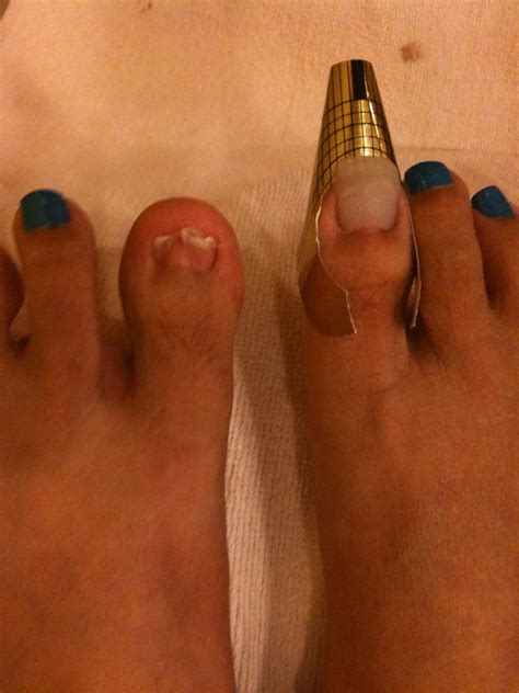 Nails Extreme: DEFORMED TOE NAILS