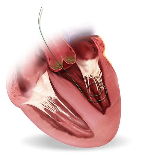 Medtronic Evolut R System Transcatheter Aortic Valve