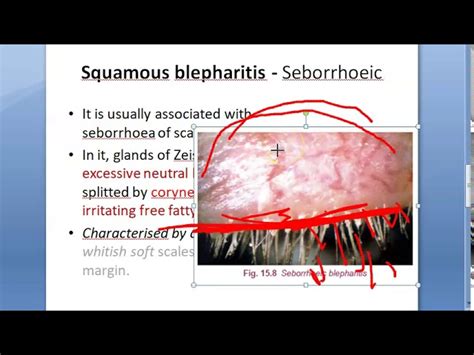 Seborrheic Blepharitis Treatment