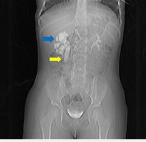 Intravenous Pyelogram Showing The Anomaly Of The Right Ureter Blue