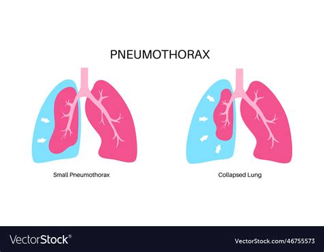 Pneumothorax Anatomical Poster Royalty Free Vector Image