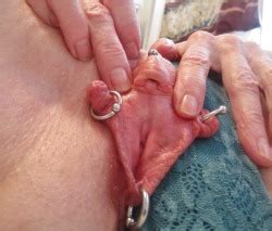 Spread Pussy With Vch Fourchette And Labial Porn Photo Pics