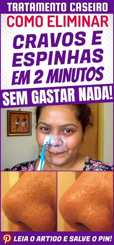 Receita Caseira Para Tirar Cravos E Espinhas Em 2 Minutos Sem Gastar