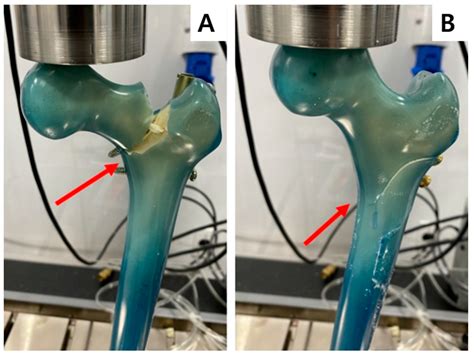 Prophylactic Femoral Neck Fixation in an Osteoporosis Femur Model: A