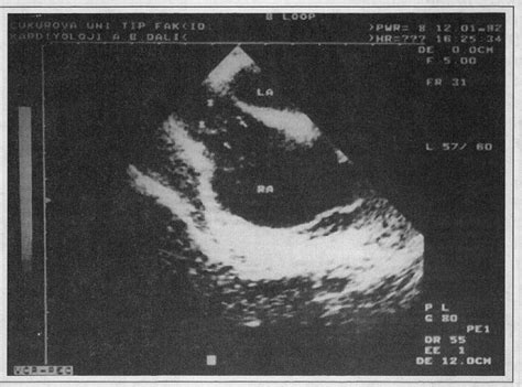 Figure From Hydatid Disease Presenting As Cardiac Tamponade