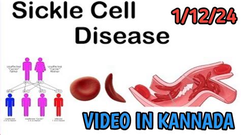 Sickle Cell Disease Hematology Anemia Pathology Pathology