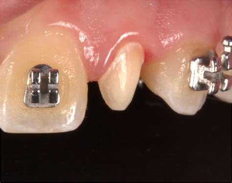 Esthetic And Functional Rehabilitation Of Peg‐shaped Maxillary Lateral