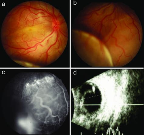 A And B Hyperemic Optic Nerve Shallow Retinal Detachment Macular