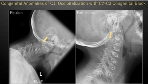 DI2 Normal Variants Congenital Anomalies 1 2 Flashcards Quizlet