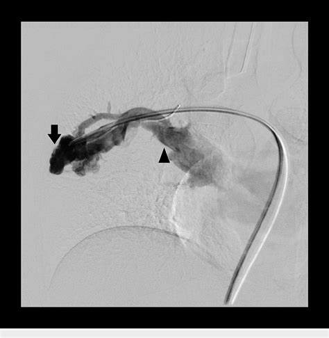 Figure From Endovascular Embolisation Of Pulmonary Arteriovenous