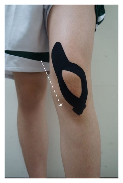 The Applications Of Kinesio Taping For Pfps Patients White Arrow Is