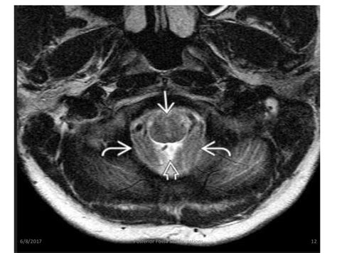 Posterior Fossa Malformations