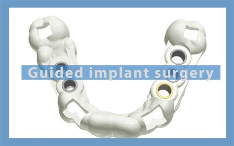 Guided implant surgery - Owandy Radiology