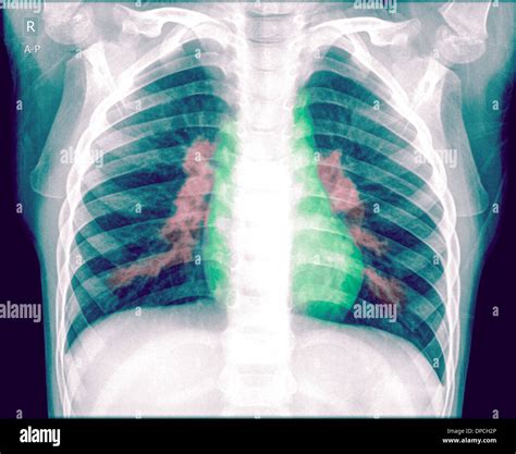 Chest X Ray Of A 3 Year Old Female Baby With Signs Of Pneumonia In